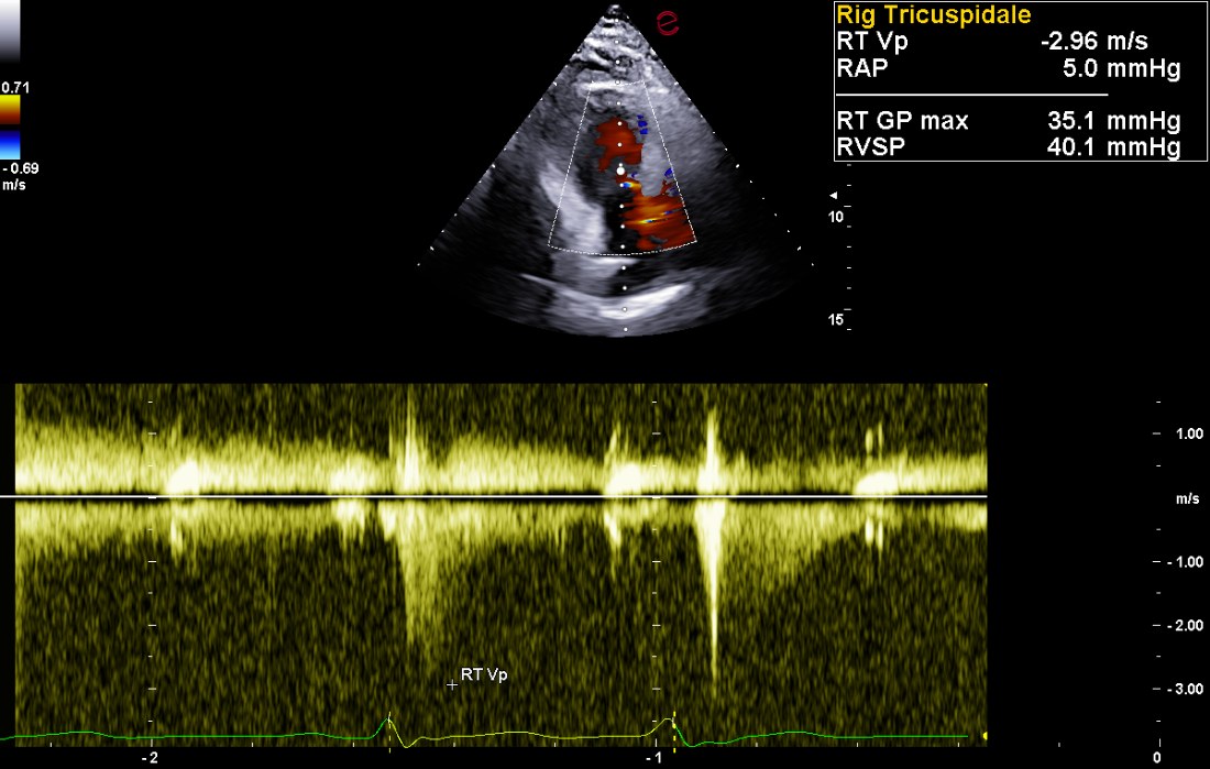 Doppler continuo sul rigurgito tricuspidale: velocità di picco 2,96 metri al secondo, gradiente 35,1 millimetri di mercurio, che sommati a una pressione atriale destra stimata di 5 danno una pressione polmonare sistolica di circa 40 millimetri di mercurio.
