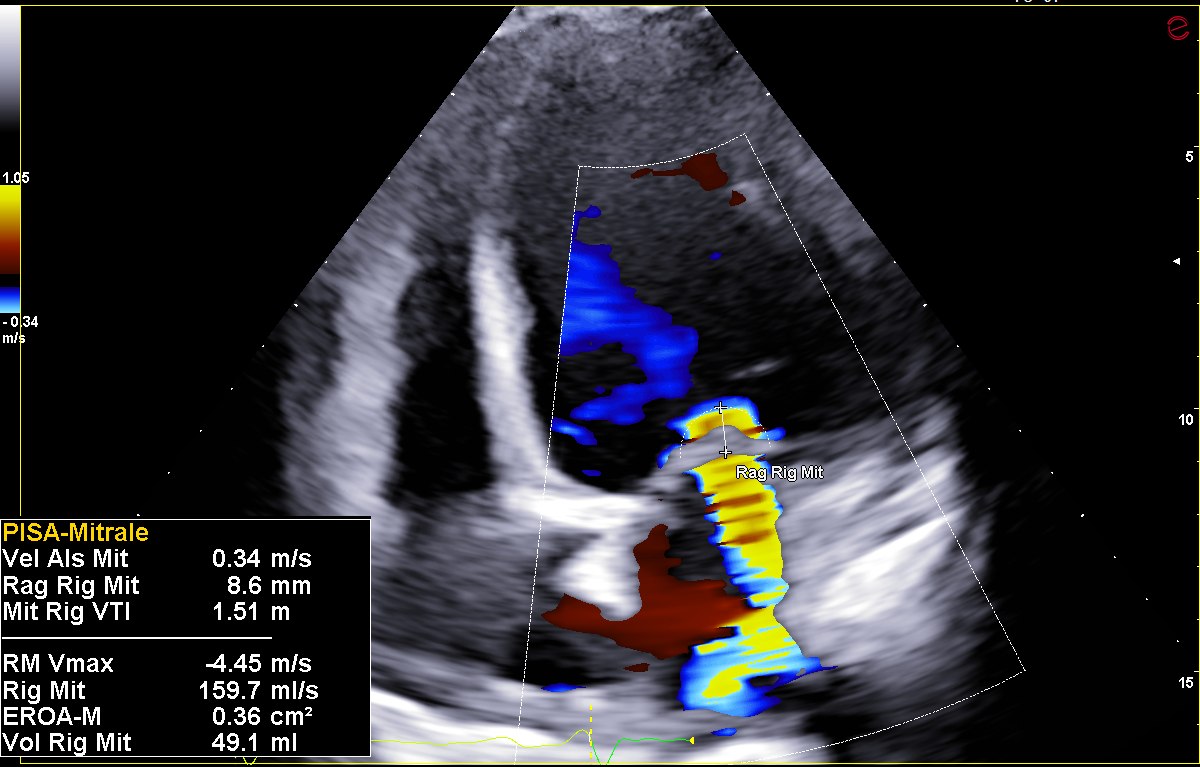 Ecocardiogramma color Doppler in proiezione apicale quattro camere: un ampio getto di rigurgito mitralico, codificato in giallo e blu, risale dal ventricolo verso l atrio sinistro. La quantificazione con il metodo PISA indica un area effettiva dell orifizio rigurgitante di 0,36 centimetri quadri e un volume rigurgitante di 49 millilitri per battito.