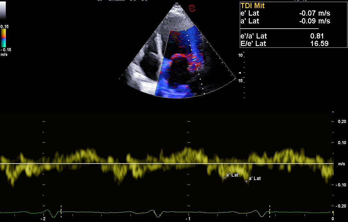 Doppler tissutale sull anello mitralico laterale: la velocita di rilasciamento e primo e di 7 centimetri al secondo, nettamente ridotta, e il rapporto fra onda E e onda e primo e di 16,6, indicativo di pressioni di riempimento elevate.