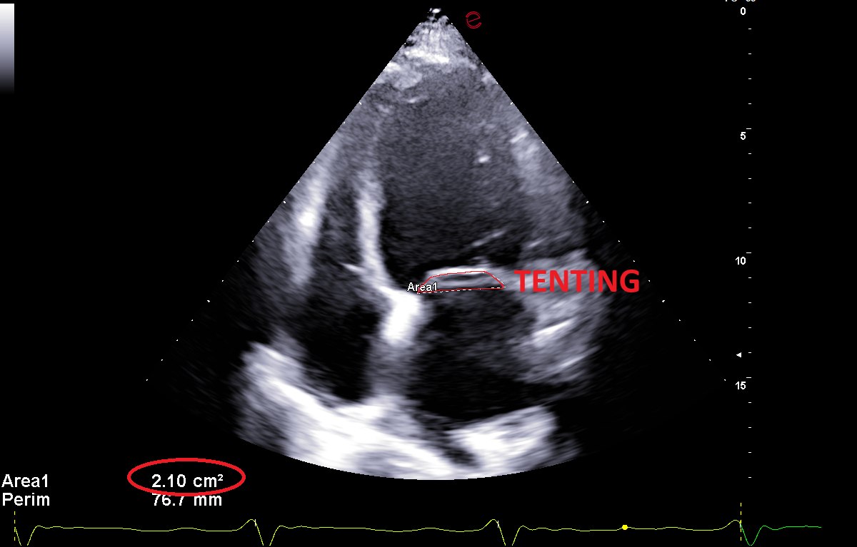 Ecocardiogramma in proiezione apicale che mostra il fenomeno del tenting della valvola mitrale: i lembi valvolari sono trattenuti verso il basso dalle corde tendinee e non riescono a chiudersi sul piano dell anello. L area di tenting misurata e di 2,10 centimetri quadri.