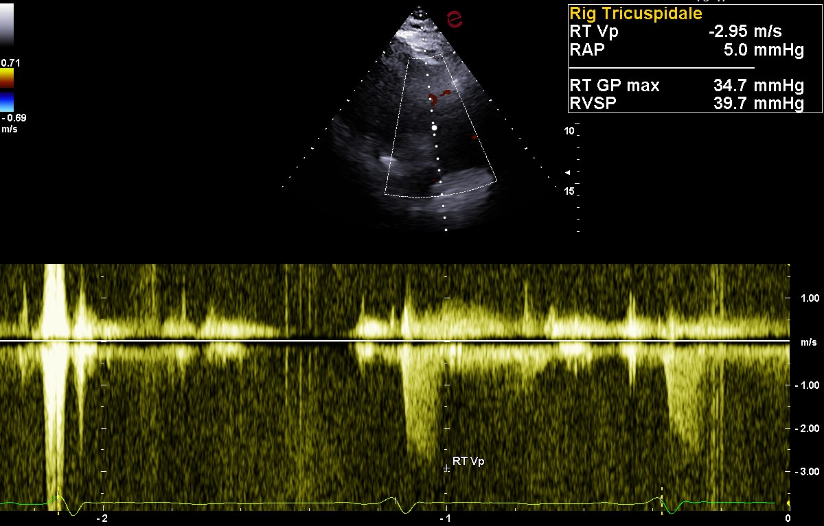 Doppler continuo sul rigurgito della valvola tricuspide: la velocita di picco e di 2,95 metri al secondo, da cui si stima una pressione sistolica in arteria polmonare di circa 40 millimetri di mercurio, compatibile con un ipertensione polmonare di grado lieve.
