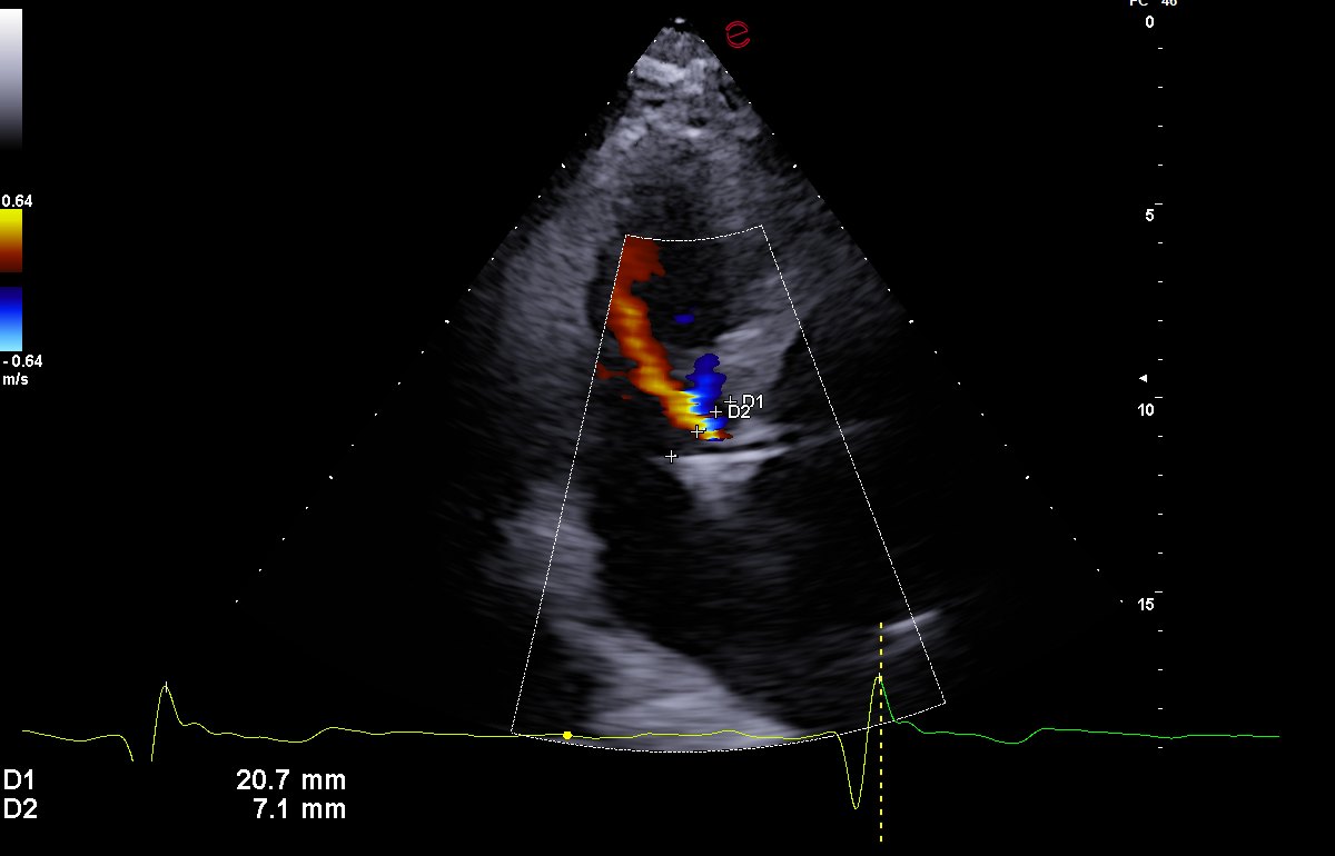 Ecocardiogramma: misurazione del rapporto fra il diametro del getto di rigurgito aortico (7,1 mm) e il diametro del tratto di efflusso del ventricolo sinistro (20,7 mm), pari al 34%.