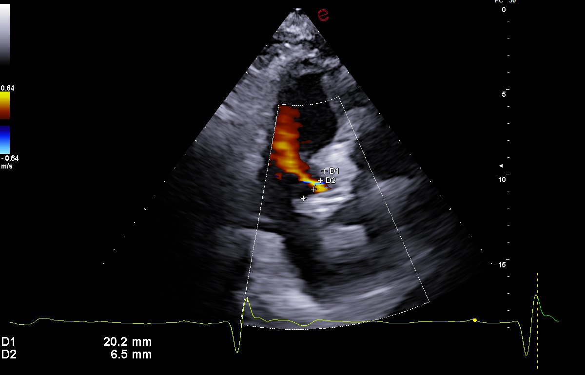 Seconda misurazione del rapporto getto/efflusso: 6,5 mm su 20,2 mm, pari al 32%. La media delle due misurazioni e riportata nel referto.