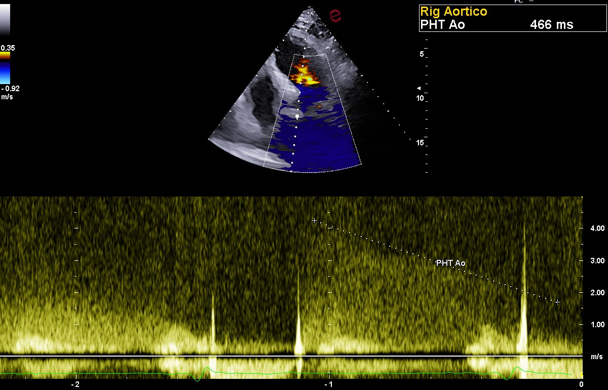 Ecocardiogramma con doppler continuo sul rigurgito aortico: il tempo di dimezzamento della pressione misura 466 millisecondi, valore compatibile con un rigurgito di grado lieve-moderato.