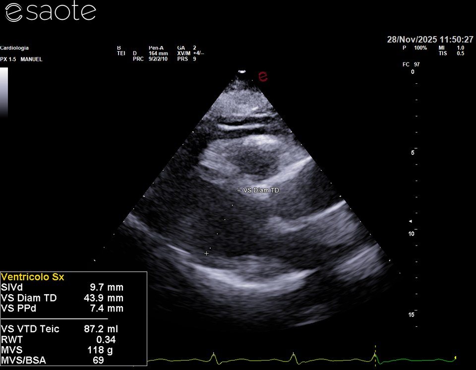 Ecocardiogramma del 28 novembre 2025, asse lungo parasternale: ventricolo sinistro di dimensioni normali, diametro telediastolico 44 mm, pareti normali.