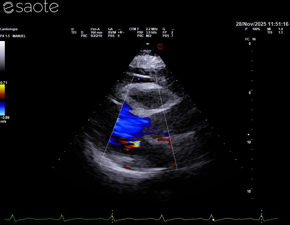 Color-Doppler del 28 novembre 2025: rigurgito mitralico lieve (1/4), getto piccolo.