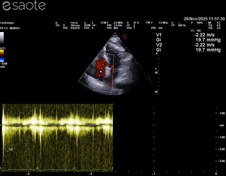 Doppler continuo del rigurgito tricuspidalico del 28 novembre 2025: velocità di picco 2,22 m/s, gradiente 19,7 mmHg, PAPS stimata circa 25 mmHg.