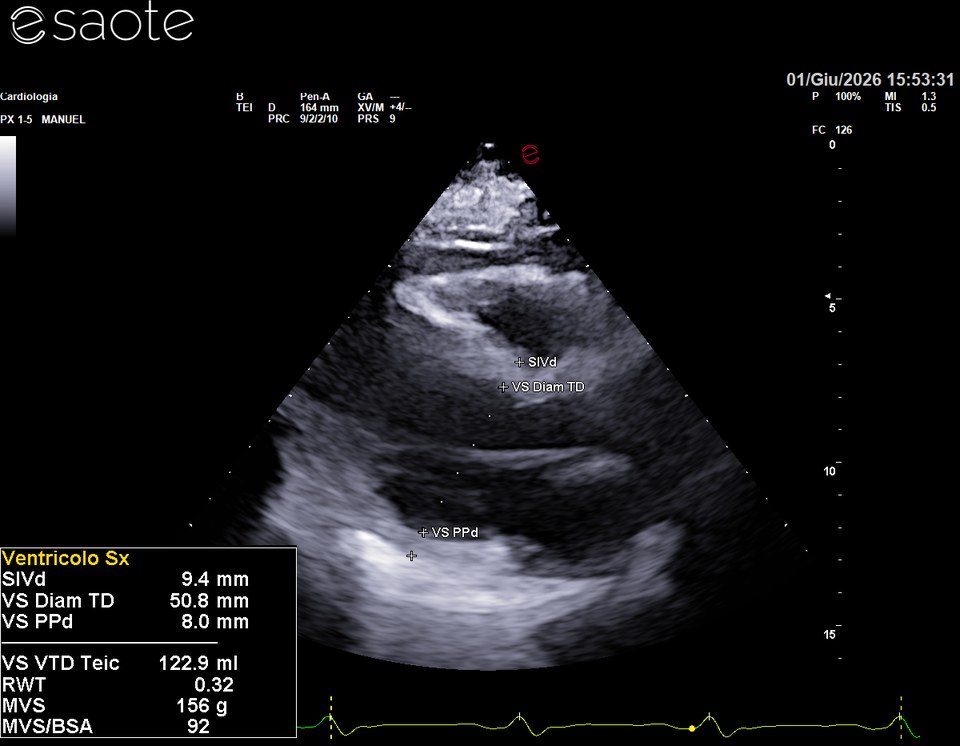Ecocardiogramma del 1 giugno 2026, asse lungo parasternale: ventricolo sinistro dilatato, diametro telediastolico 50,8 mm (era 44 mm a novembre), volume telediastolico 122,9 ml.