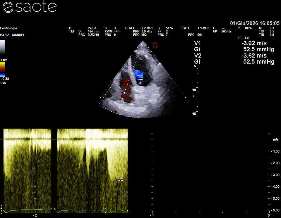 Doppler continuo del rigurgito tricuspidalico del 1 giugno 2026: velocità di picco 3,62 m/s, gradiente 52,5 mmHg, PAPS stimata circa 60 mmHg.