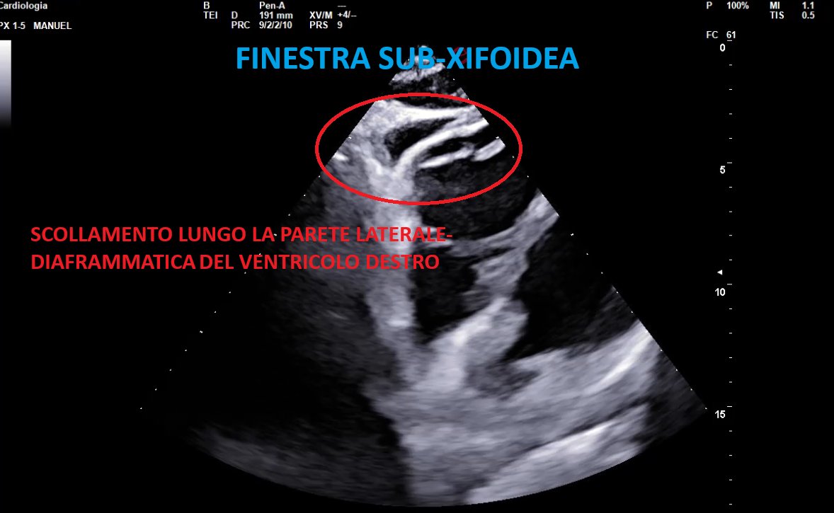 Immagine ecocardiografica in finestra sub-xifoidea: si vede il cuore in sezione con il ventricolo destro appoggiato al diaframma; nella regione tra parete cardiaca e pericardio è cerchiata in rosso un'area di scollamento dei foglietti pericardici lungo la parete laterale-diaframmatica del ventricolo destro.