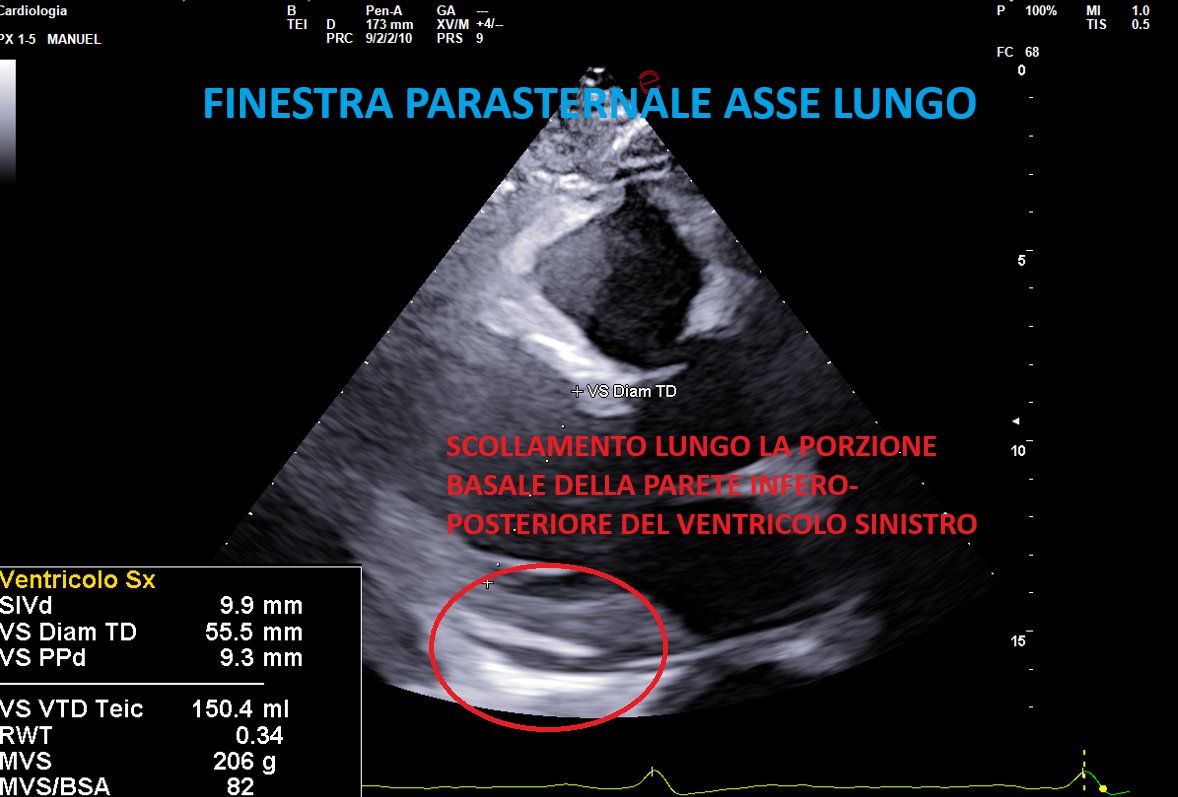 Immagine ecocardiografica in finestra parasternale asse lungo: si vede il ventricolo sinistro in sezione longitudinale, con misure SIV 9.9 mm, VS Diam TD 55.5 mm, PPd 9.3 mm, RWT 0.34; nella parte inferiore dell'immagine è cerchiata in rosso un'area di scollamento dei foglietti pericardici lungo la porzione basale della parete infero-posteriore del ventricolo sinistro.