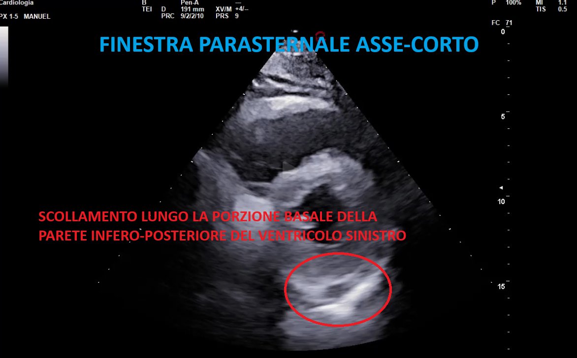 Immagine ecocardiografica in finestra parasternale asse corto: si vede il cuore in sezione trasversale, con il ventricolo sinistro al centro; nella regione basale infero-posteriore è cerchiata in rosso la stessa area di scollamento dei foglietti pericardici vista nella finestra precedente, confermando la sede del reperto.