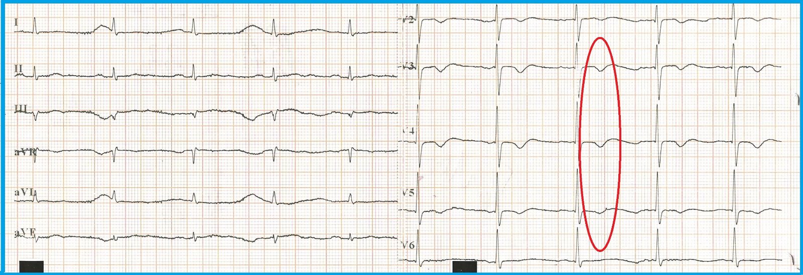 Elettrocardiogramma a riposo del novembre 2024: onde T invertite nelle derivazioni precordiali da V2 a V5, evidenziate in rosso, e T appiattite nelle derivazioni periferiche.
