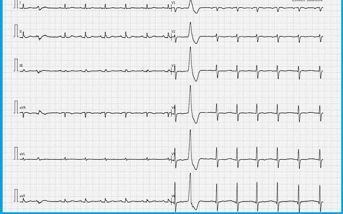 Elettrocardiogramma a dodici derivazioni registrato durante la scintigrafia, sei giorni dopo il precedente: le onde T invertite non sono piu presenti.