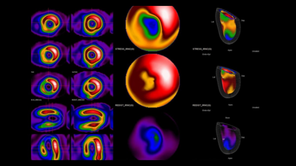 Scintigrafia miocardica — Prontocardiologia
