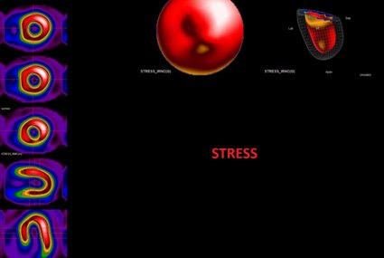 Mappa tridimensionale della perfusione dopo lo stenting: la superficie del ventricolo sinistro appare uniforme, senza l'area di ridotta perfusione presente nell'esame precedente.