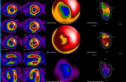 Mappe tridimensionali della perfusione prima della procedura: in alto la superficie sotto sforzo con un'ampia area blu e verde di ridotta perfusione, al centro la stessa superficie a riposo in gran parte riempita, in basso la mappa differenza che isola la componente reversibile.