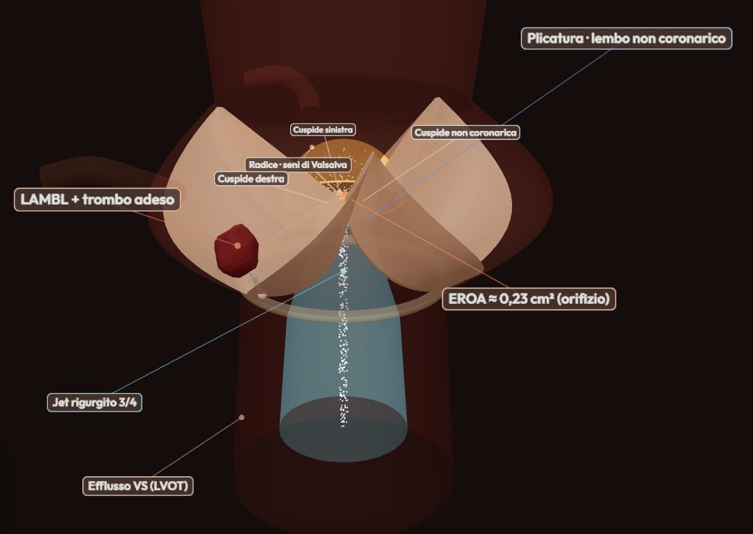 Un trombo su un filamento di due millimetri: storia di un'escrescenza di Lambl dopo chirurgia valvolare — Prontocardiologia