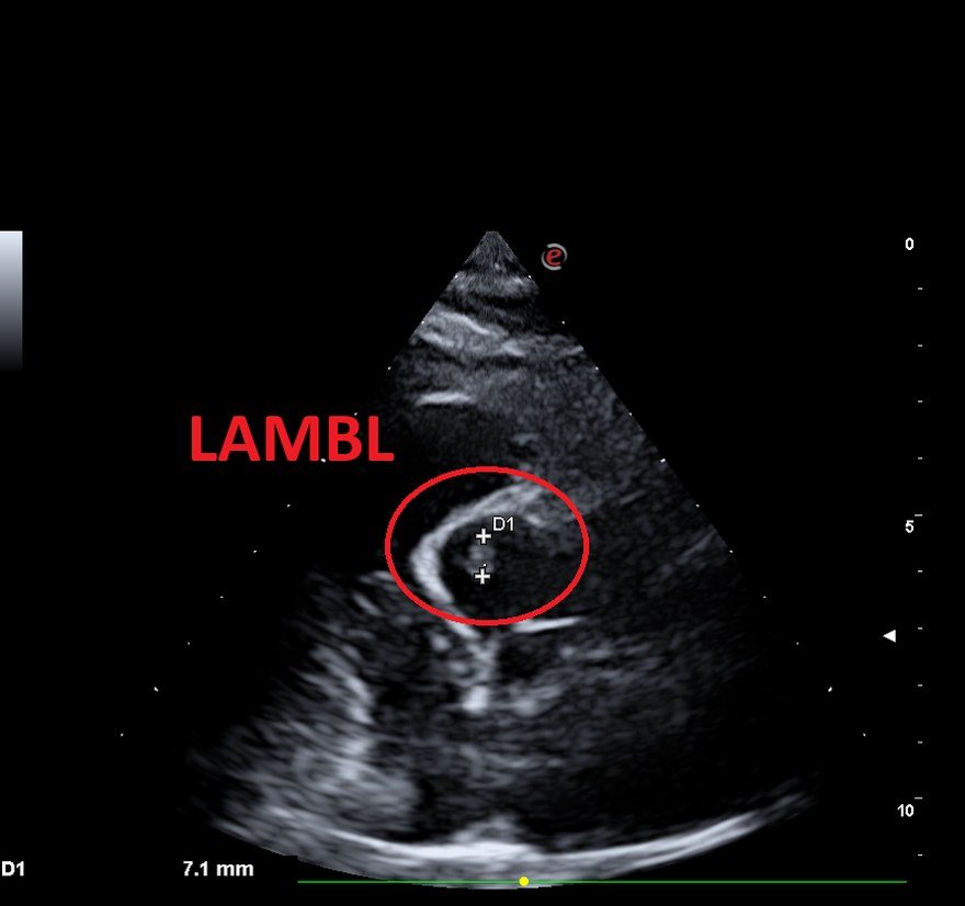 Ecocardiogramma dell’ottobre 2023, dettaglio del trombo adeso al Lambl sulla cuspide aortica destra.