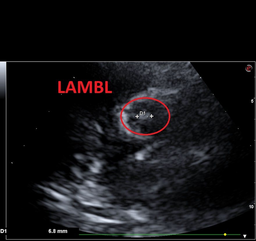 Ecocardiogramma del gennaio 2024: il trombo sul Lambl appare ridotto di dimensioni e meno iperecogeno rispetto ai controlli precedenti.