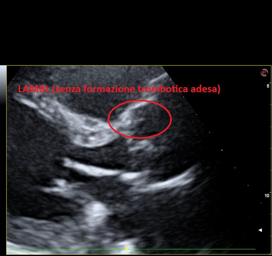 Ecocardiogramma del maggio 2024: il Lambl è ancora presente sulla cuspide aortica destra ma la formazione trombotica è scomparsa.