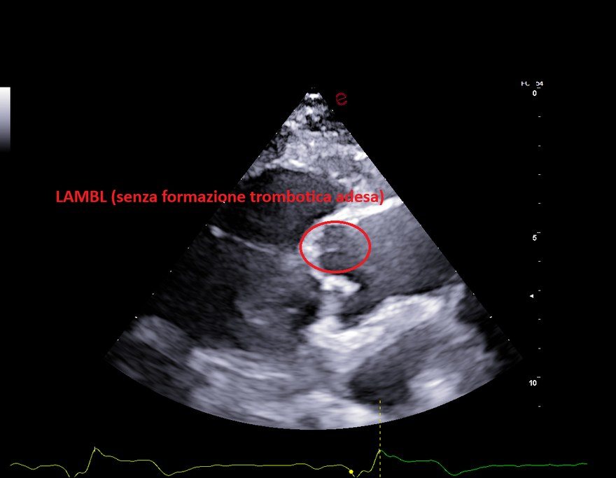 Ecocardiogramma del giugno 2026: il Lambl persiste sulla cuspide aortica destra, libero da trombi, durante terapia con Eliquis.
