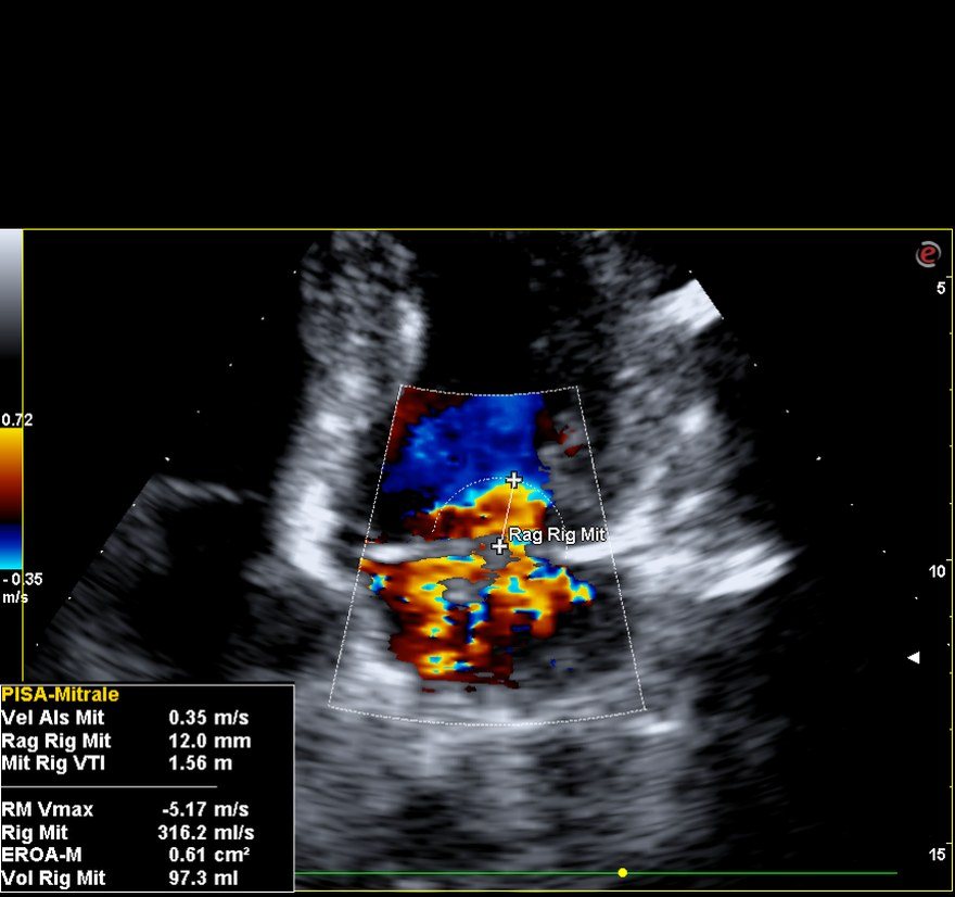 Ecocardiogramma color Doppler del gennaio 2022 con misura PISA del rigurgito mitralico severo, EROA 0,61 cm² e volume rigurgitante 97 ml.