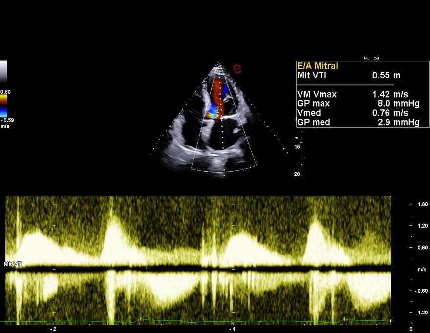 Tracciato Doppler continuo della valvola mitrale, giugno 2026: gradiente medio di circa 2,8 mmHg, indicativo di stenosi residua lieve.