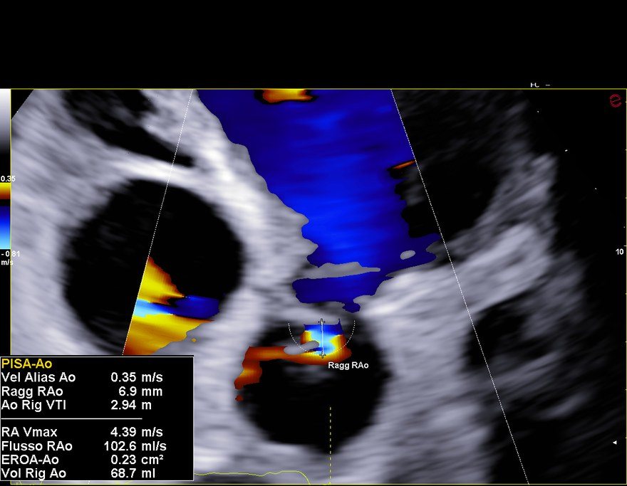 Ecocardiogramma color Doppler del giugno 2026 con misura PISA del rigurgito aortico: raggio 6,9 mm, EROA 0,23 cm², volume rigurgitante 68,7 ml.
