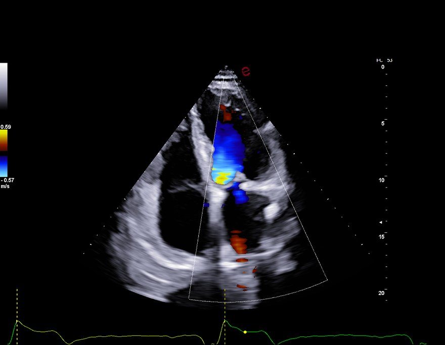 Ecocardiogramma apicale color Doppler del giugno 2026: ampio getto di rigurgito aortico diretto verso il ventricolo sinistro; a livello della valvola mitrale riparata il colore è minimo.