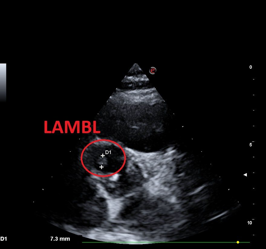 Ecocardiogramma dell’ottobre 2023 con escrescenza di Lambl alla base della cuspide aortica destra, annotata e cerchiata.