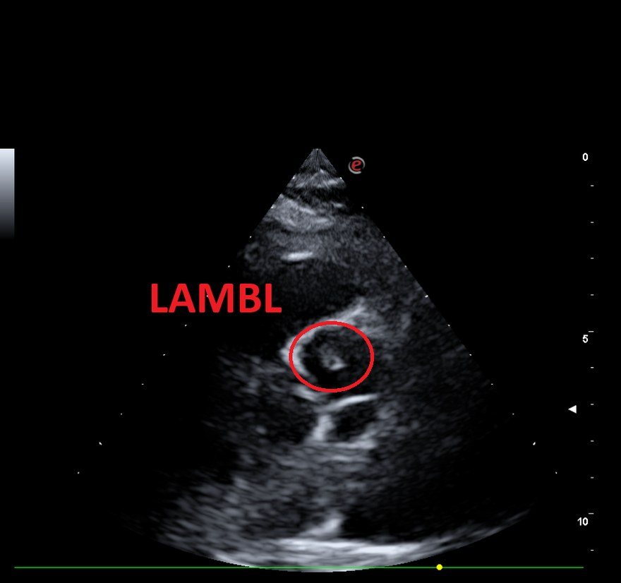 Ecocardiogramma dell’ottobre 2023 con escrescenza di Lambl alla base della cuspide aortica destra, evidenziata e cerchiata.
