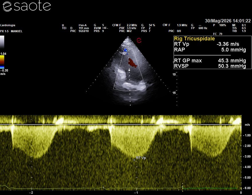 Stima della pressione polmonare dal flusso di rigurgito tricuspidale: pressione sistolica polmonare circa 50 mmHg