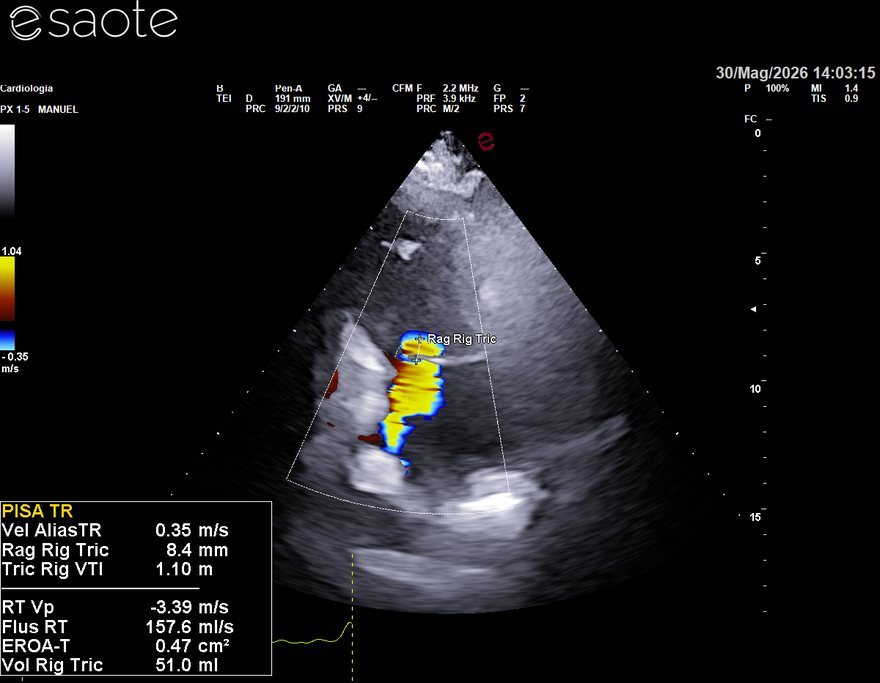 Quantificazione del rigurgito tricuspidale con metodo PISA: orifizio rigurgitante efficace 0,47 cm², rigurgito di grado severo
