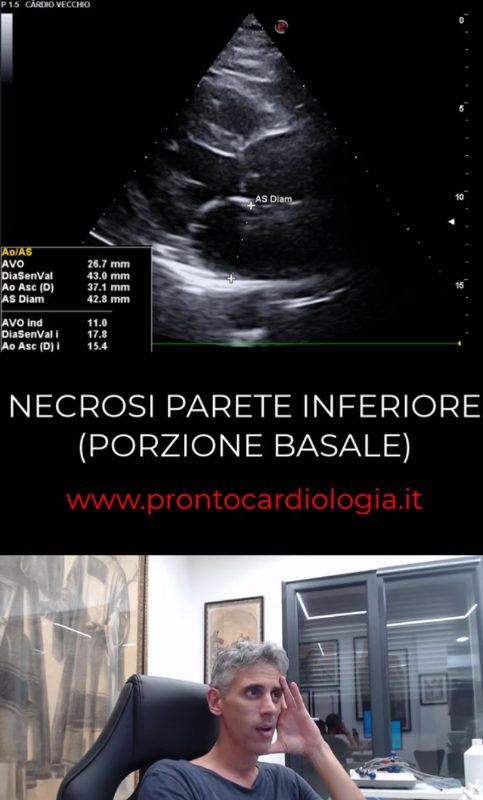 Anteprima caso clinico: NECROSI PARETE INFERIORE (Porzione Basale)