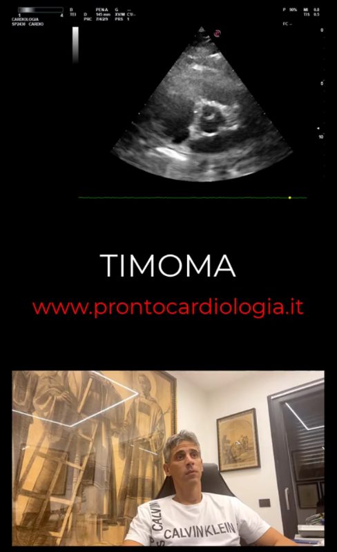 Anteprima caso clinico: TIMOMA