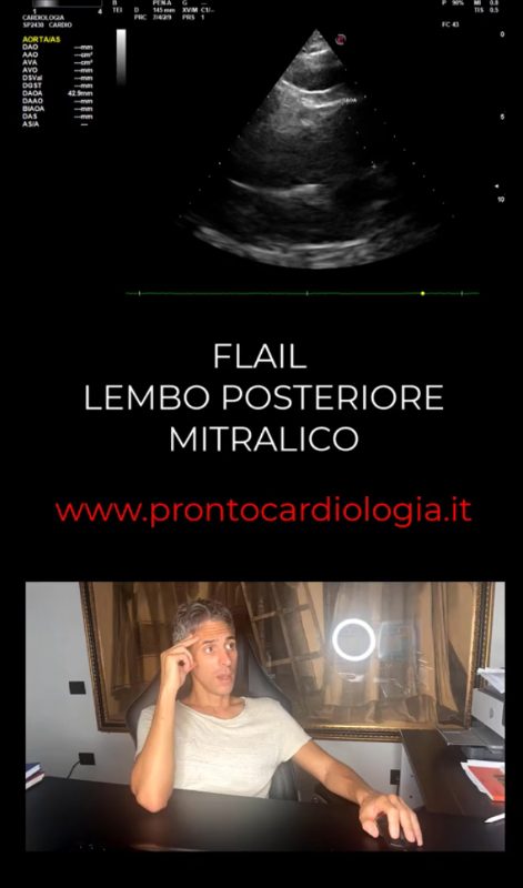 Anteprima caso clinico: FLAIL LEMBO POSTERIORE