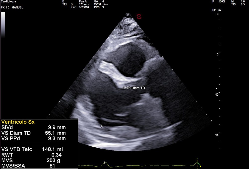 Ecocardiogramma acquisito con ESAOTE MyLab X90 — immagine nitida e definita